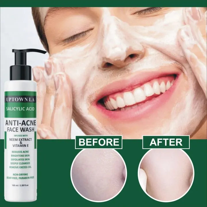 UPTOWN LA Anti Acne Face Wash – Oil Control Cleanser for Acne, Blackheads & Whiteheads | Deep Pore Cleansing Face Wash