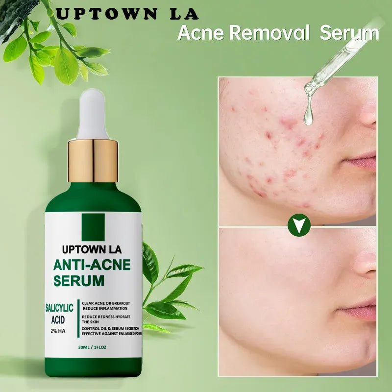UPTOWN LA Anti Acne Serum with Salicylic Acid 30ml | Acne Treatment, Oil Control & Pore Minimizing Face Serum